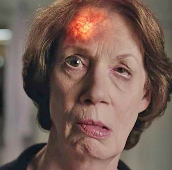 sinais do avc sinais do avc