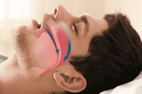 sintomas da apneia do sono