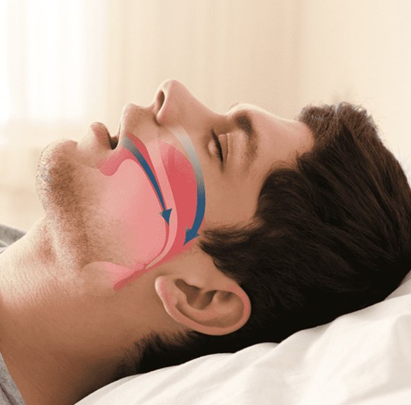 sintomas da apneia do sono sintomas da apneia do sono