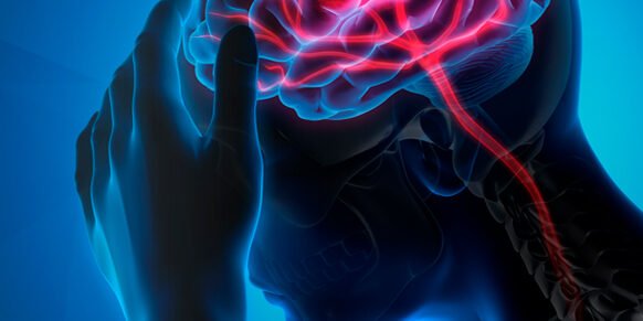 tratamento de avc tratamento de avc