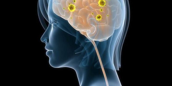 O que é Neurossífilis e Quais os Sintomas? O que é Neurossífilis e Quais os Sintomas?