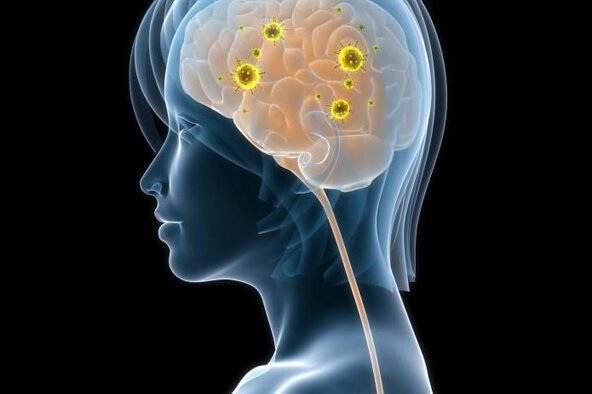 O que é Neurossífilis e Quais os Sintomas?