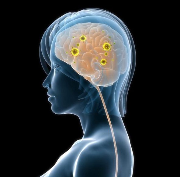 O que é Neurossífilis e Quais os Sintomas?