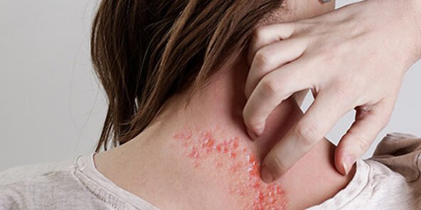 herpes zoster herpes zoster