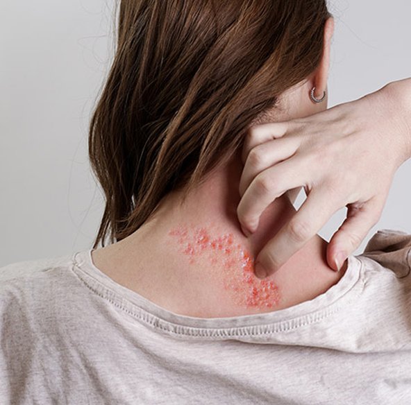 herpes zoster herpes zoster