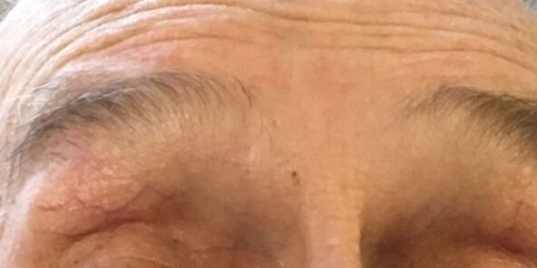 Distrofia muscular oculofaríngea (OPDM) O que é Distrofia Muscular Oculofaríngea (OPMD)?