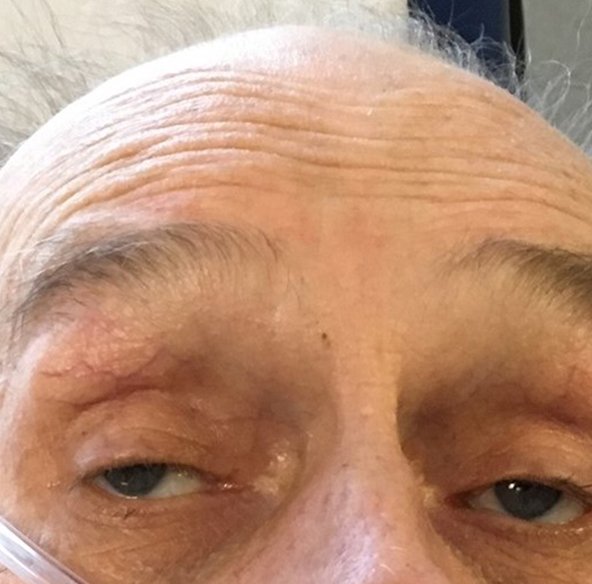 Distrofia muscular oculofaríngea (OPDM) O que é Distrofia Muscular Oculofaríngea (OPMD)?