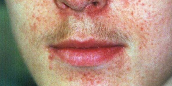 Esclerose tuberosa Esclerose tuberosa