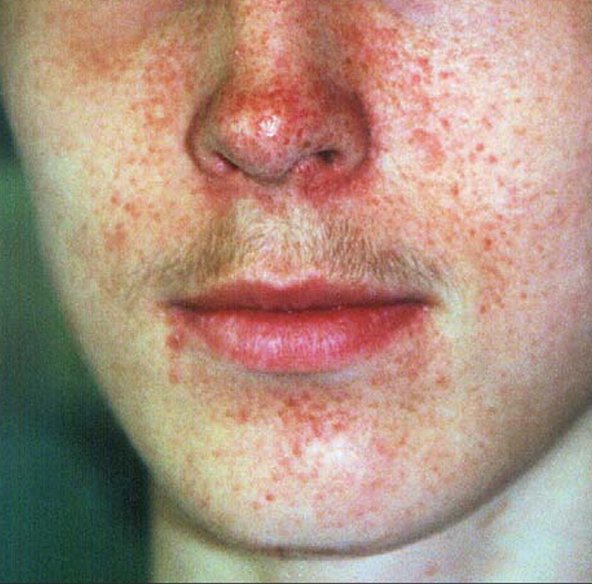 Esclerose tuberosa Esclerose tuberosa