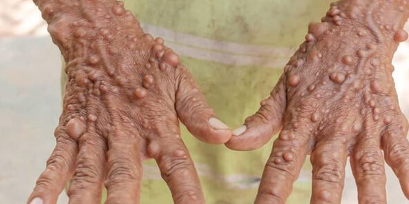 O que é Neurofibromatose? O que é Neurofibromatose?