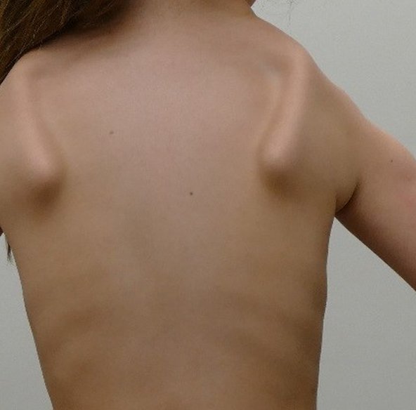 O que é Distrofia Muscular Facio Escápulo Umeral (FSH)? O que é Distrofia Muscular Facio Escápulo Umeral (FSH)?