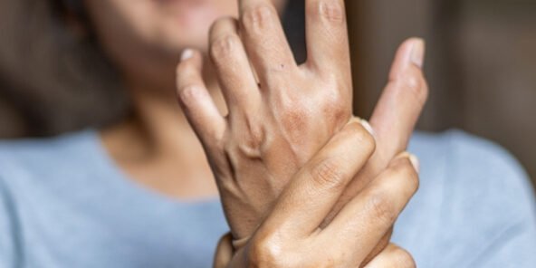 Síndrome Dolorosa Regional Complexa