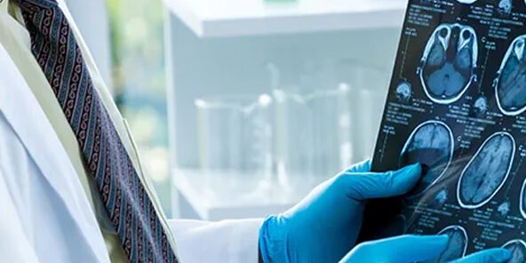 O que é Síndrome de Rasmussen O que é Síndrome de Rasmussen