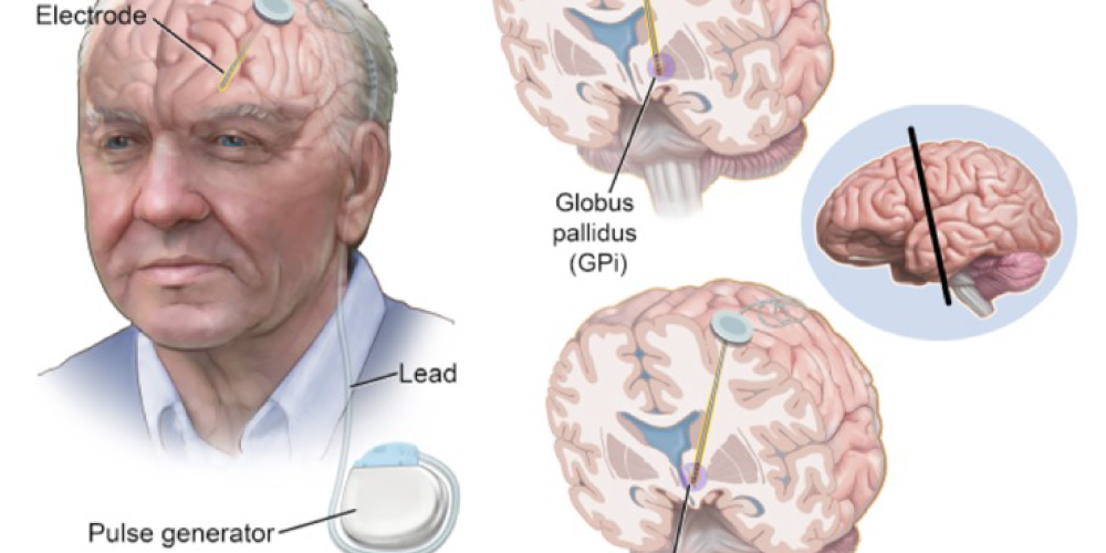 Deep Brain Stimulation