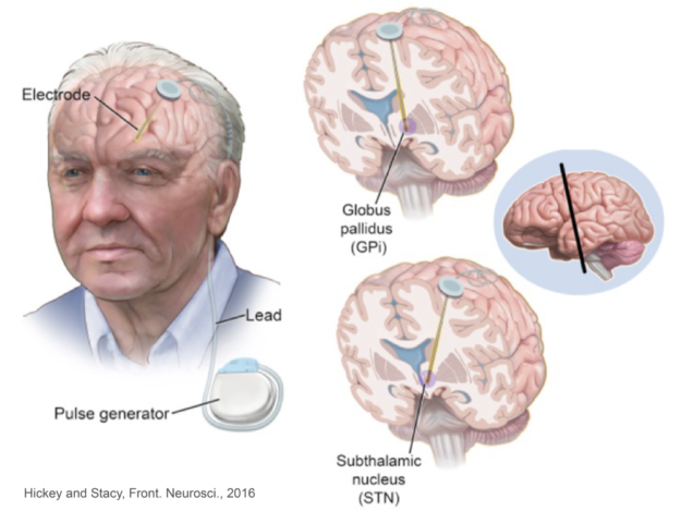 Deep Brain Stimulation